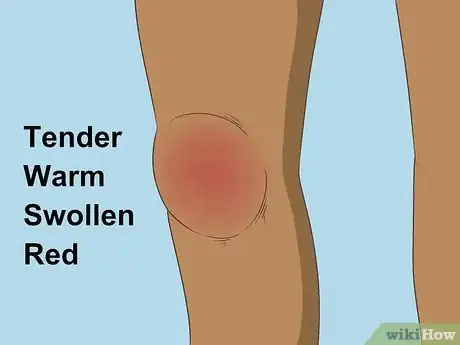 Image titled Diagnose Bursitis Step 8