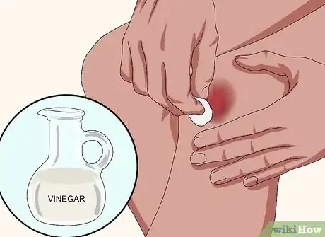 Image titled Heal a Bruise Step 8