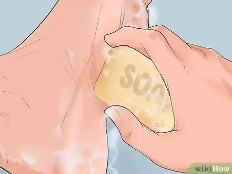 Image titled Identify and Treat Injuries From Stingrays and Sea Urchins Step 19