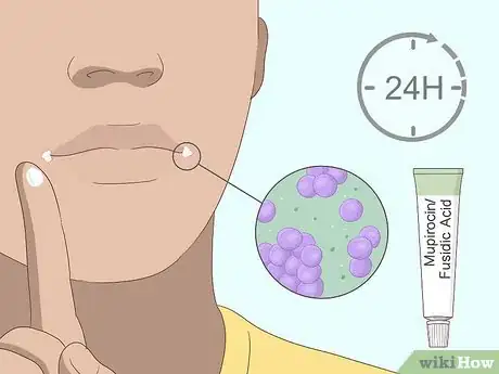 Image titled Cure Angular Cheilitis Step 8