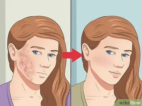 Image titled Start Using Accutane Step 21