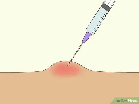 Image titled Prevent Cystic Acne Step 10