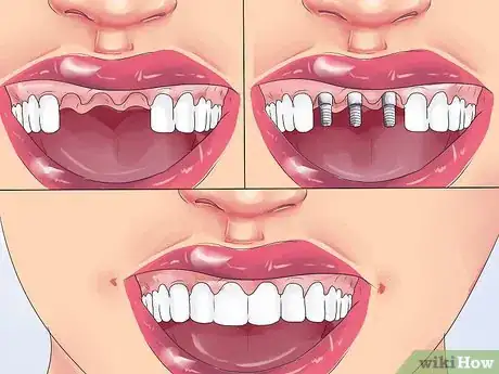 Image titled Handle Tooth Loss Step 10