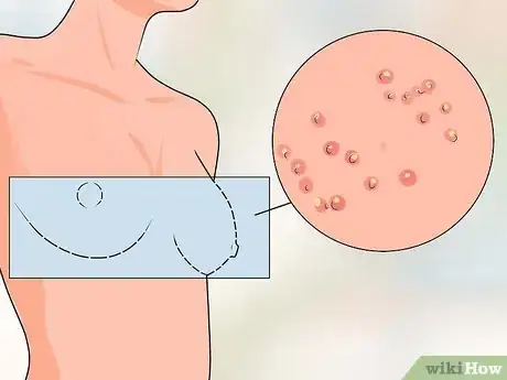 Image titled Treat Itchy Breasts Step 11