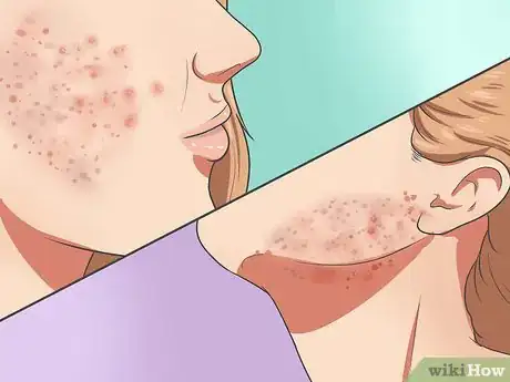 Image titled Start Using Accutane Step 2