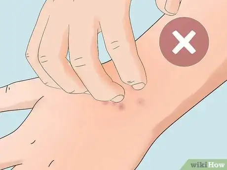 Image titled Treat Infected Insect Bites at Home Step 9