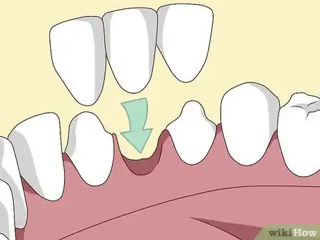 Image titled Replace a Tooth Step 8