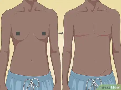 Image titled Pick a Surgeon for Top Surgery Step 9