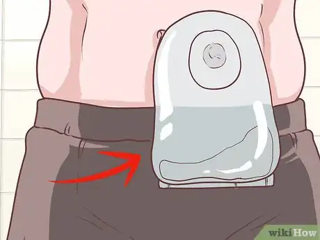 Image titled Treat Colon Cancer Step 3