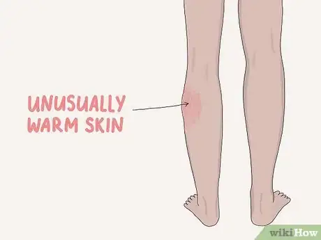 Image titled Diagnose and Treat Thrombophilia Step 2