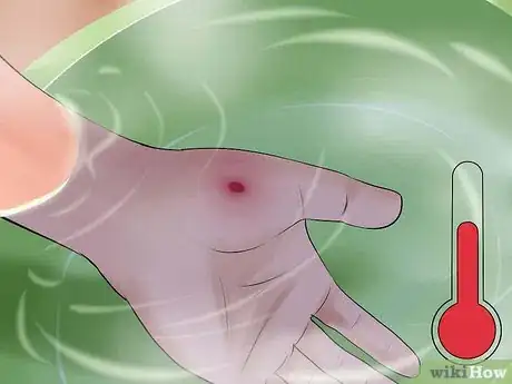 Image titled Identify and Treat Injuries From Stingrays and Sea Urchins Step 7