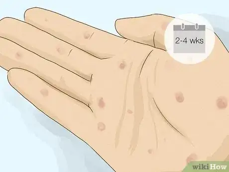 Image titled Test for Nongenital STIs Step 7