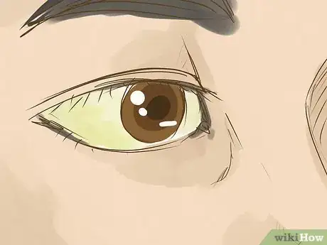 Image titled Diagnose Liver Cancer Step 6