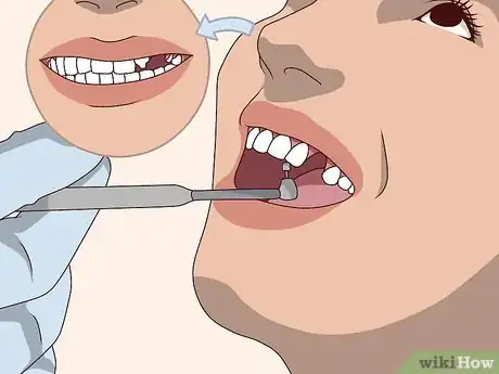 Image titled Replace a Tooth Step 7