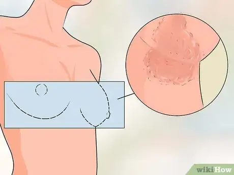 Image titled Treat Itchy Breasts Step 10