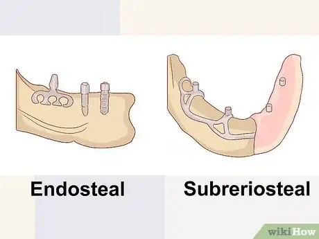 Image titled Know What to Expect when Getting a Tooth Implant Step 4