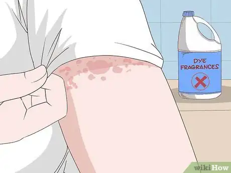 Image titled Avoid Triggers for Chronic Hives Step 6