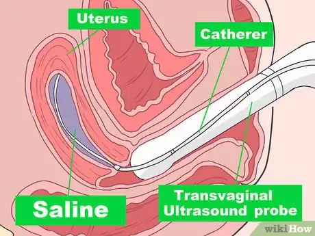 Image titled Detect Uterine Cancer Step 7