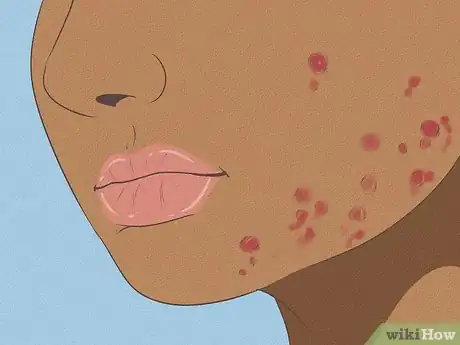 Image titled Get Rid of Acne if You Have Fair Skin Step 10