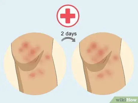 Image titled Soothe Itchy Legs Step 29