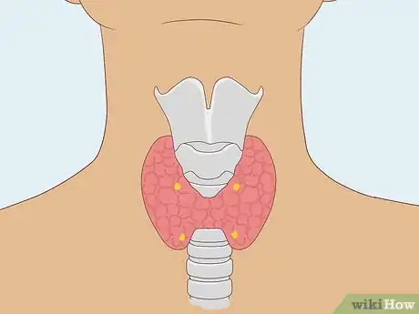 Image titled Treat Hypocalcemia Step 8