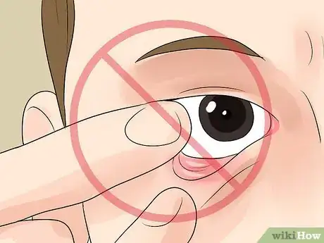 Image titled Diagnose Pink Eye Step 10