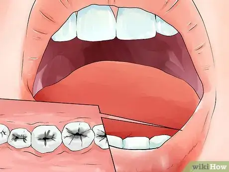 Image titled Identify if You Have Sensitive Teeth Step 10