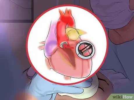 Image titled Cope With Mitral Valve Prolapse (MVP) Step 9