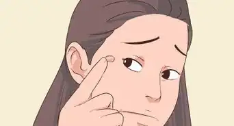 Get a Wart Surgically Removed