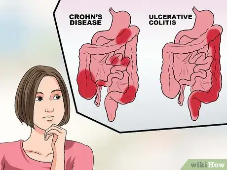 Image titled Recognize the Symptoms of Inflammatory Bowel Disease Step 15