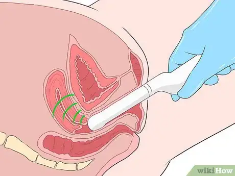 Image titled Detect Uterine Cancer Step 6