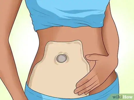 Image titled Recover from Crohn's Surgery Step 7