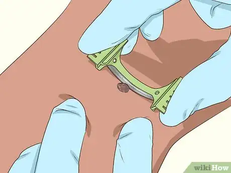 Image titled Undergo a Mole Biopsy Step 2