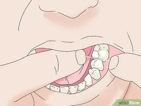 Image titled Clean Wisdom Teeth Step 6