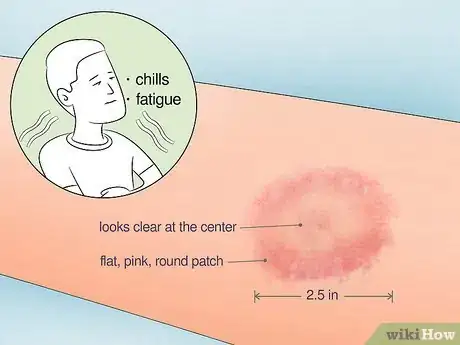 Image titled Get a Tick Head Out Step 8