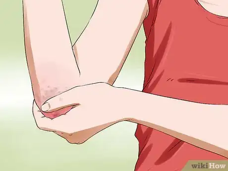 Image titled Know if You Have Eczema Step 1