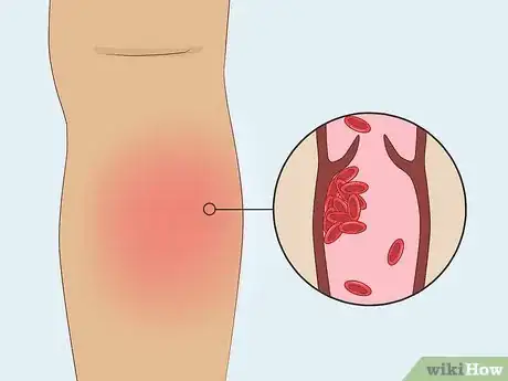 Image titled Use the Birth Control Patch Step 9