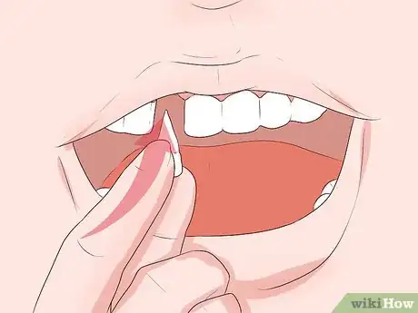 Image titled Take Care of Your Loose Teeth Step 11