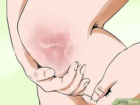 Image titled Know if You Have Eczema Step 5