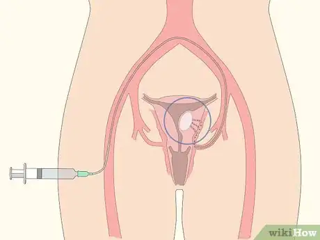 Image titled Treat Menorrhagia Step 7
