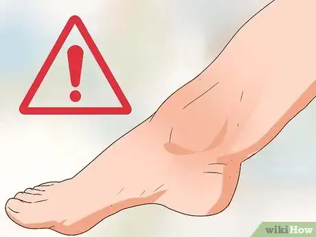 Image titled Use Compression Therapy Step 13