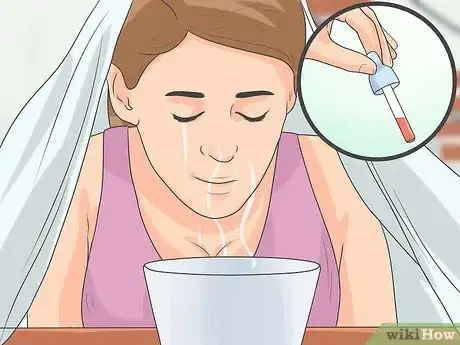 Image titled Treat Cystic Acne Naturally Step 8