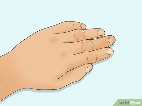 Image titled Diagnose Rheumatoid Arthritis Step 9