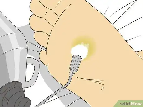 Image titled Freeze Plantar Warts Step 9