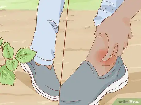 Image titled Get Rid of Poison Ivy Rashes Step 2