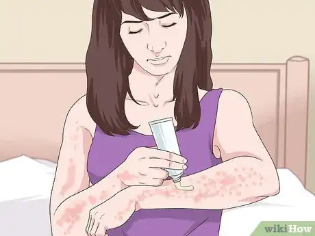 Image titled Soothe Psoriasis Itching Step 4