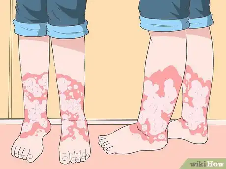 Image titled Recognize the Signs of Graves' Disease Step 8