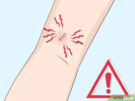 Image titled Undergo a Mole Biopsy Step 5