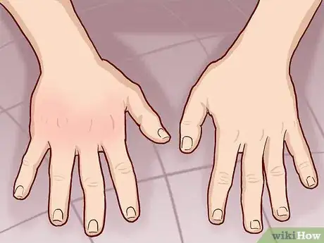 Image titled Know If Your Knuckle Is Broken Step 5