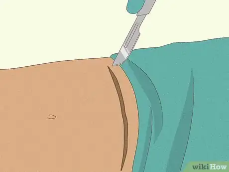 Image titled Lighten a C‐Section Scar Step 9